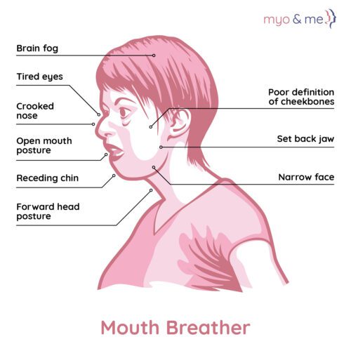 Mouth breathing can lead to a number of Orofacial Myofunctional Disorders that we aim to resolve through Myofunctional Therapy